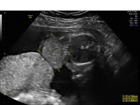 Omphalocele axial view